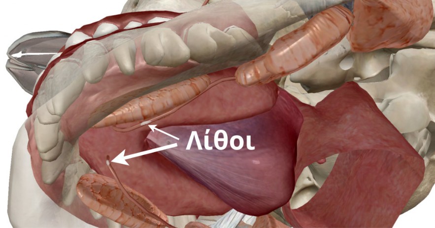 Sialolithiasis