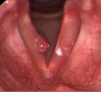 πολύποδες φωνητικών χορδών, vocal cords polyps 