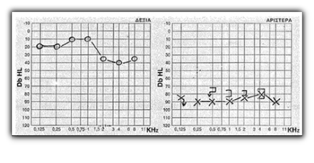 http://www.orl-med.gr αιφνίδια βαρηκοία ξαφνική πτώση ακοής