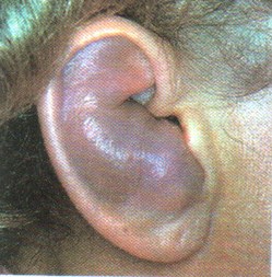 http://www.orl-med.gr ωταιμάτωμα http://www.orl-med.gr ωταιμάτωμα