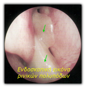Πολύποδες ρινός